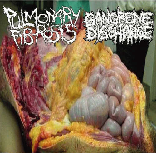 Gangrene Discharge : Pulmonary Fibrosis - Gangrene Discharge